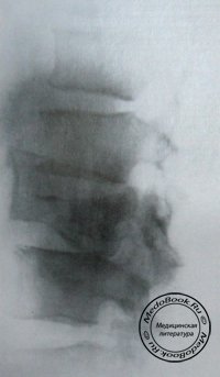 Рентгеновский снимок боковой проекции оскольчатого перелома 2 поясничного позвонка с подвывихом