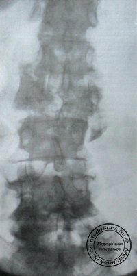 Рентгеновский снимок прямой проекции оскольчатого перелома 2 поясничного позвонка с подвывихом