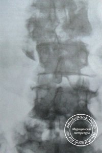 Рентгенологическая диагностика оскольчатого перелома 2 поясничного позвонка с подвывихом