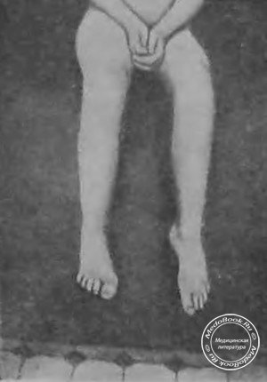 Паралич тыльных сгибателей правой стопы при переднем полиомиелите — паралитическая конская стопа