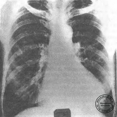 Обзорная рентгенограмма грудной клетки при склеродермии: определяется базальный пневмофиброз
