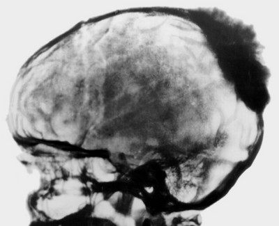 Рентген черепа с остеогенной остеосаркомой