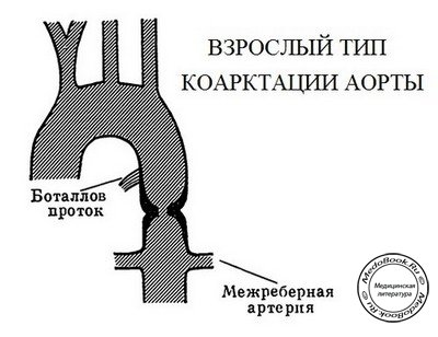 Схематическое изображение взрослого типа коарктации аорты