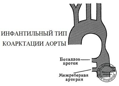 Схематическое изображение инфантильного типа коарктации аорты
