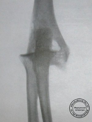 Задний снимок заднего лучевого вывиха в локтевом суставе со смещением в лучевую и проксимальную стороны