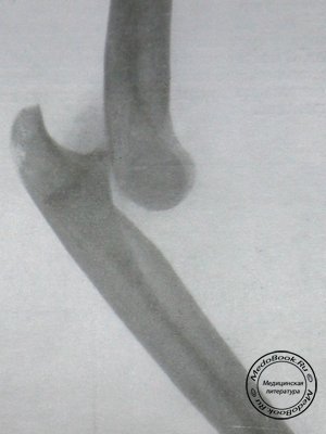 Боковой снимок заднего лучевого вывиха в локтевом суставе со смещением кзади