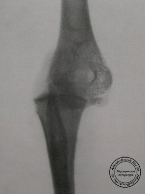 Задний снимок заднего лучевого вывиха в локтевом суставе у 12-летнего ребенка