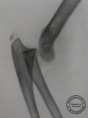 Боковой снимок заднего лучевого вывиха в локтевом суставе у 12-летнего ребенка
