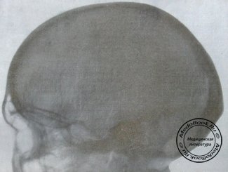 Боковой снимок перелома в области лобной, височной и теменной костей с переломом основания черепа