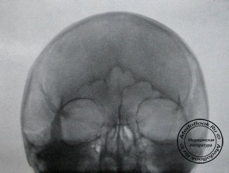 Прямой снимок перелома в области лобной, височной и теменной костей с переломом основания черепа