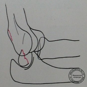 Схема к боковому снимку переломо-вывиха в локтевом суставе