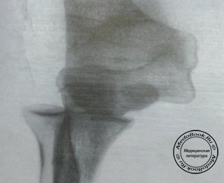 Задний снимок переломо-вывиха в локтевом суставе