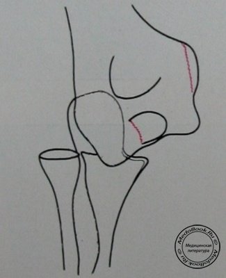 Схема к заднему снимку переломо-вывиха в локтевом суставе