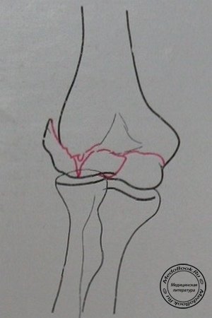 Схема к заднему рентгеновскому снимку перелома головки плечевой кости, блока и латерального мыщелка