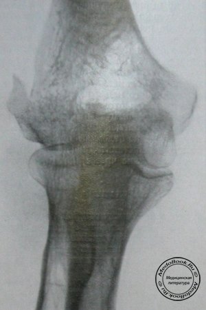 Задний рентгеновский снимок перелома головки плечевой кости, блока и латерального мыщелка