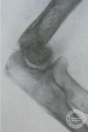 Боковой рентгеновский снимок перелома головки плечевой кости, блока и латерального мыщелка