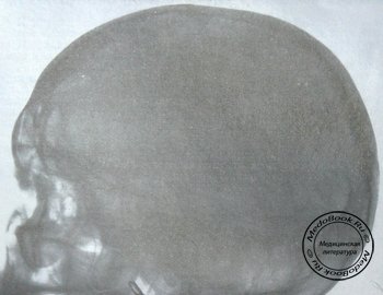 Боковой рентгеновский снимок перелома лобной кости, верхней челюсти и скуловой дуги