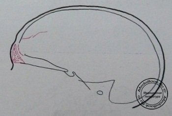 Схема к боковому рентгеновскому снимку перелома лобной кости, верхней челюсти и скуловой дуги