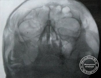 Полуаксиальный рентгеновский снимок перелома лобной кости, верхней челюсти и скуловой дуги
