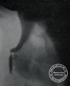 Рентгеновский снимок поперечного перелома носовой кости