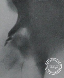 Рентгеновский снимок двойного поперечного перелома носовой кости
