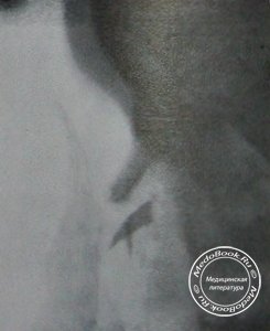 Рентгеновский снимок поперечного перелома носовой кости со смещением