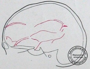 Схема к боковому рентгеновскому снимку импрессионного перелома черепа