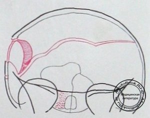 Схема к заднему рентгеновскому снимку импрессионного перелома черепа