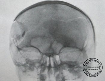 Задний рентгеновский снимок импрессионного перелома черепа