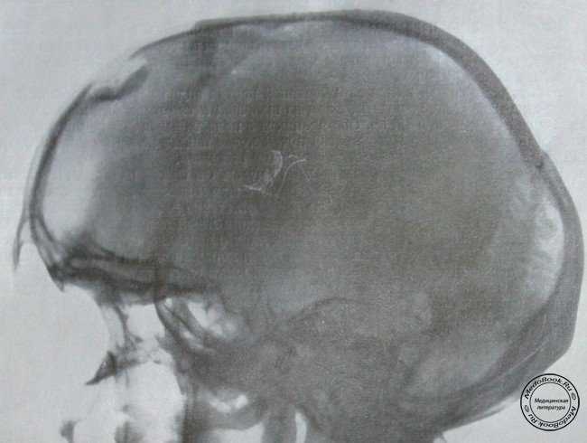 Боковой рентгеновский снимок импрессионного перелома лобной кости