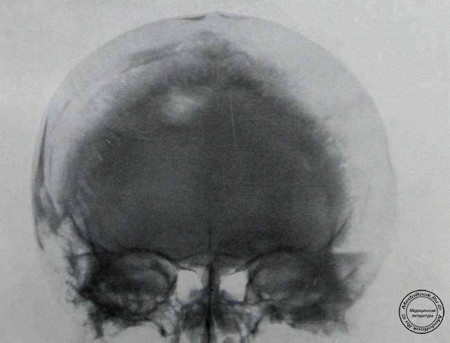 Прямой рентгеновский снимок импрессионного перелома лобной кости