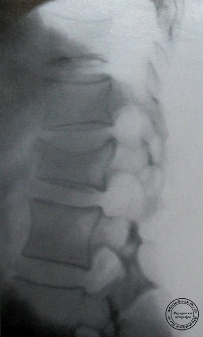 Боковой рентгеновский снимок компрессионного перелома 1 поясничного позвонка