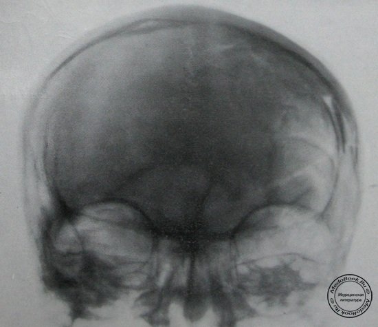 Задний рентгеновский снимок импрессионного перелома лобной и теменной костей с переломом основания черепа