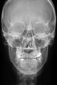 Перелом в области лобной, височной и теменной костей с переломом основания черепа