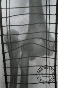 Рентгенодиагностика открытого заднего локтевого вывиха