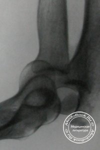 Рентгенодиагностика переломо-вывиха в локтевом суставе
