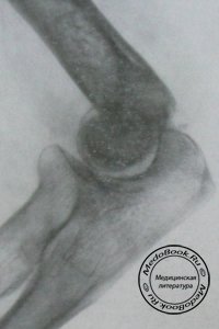 Перелом головки плечевой кости, блока и латерального мыщелка: Рентгенодиагностика