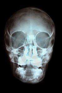 Перелом лобной кости, верхней челюсти и скуловой дуги: Рентгенодиагностика