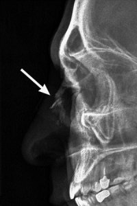 Повреждение носовой кости: Рентгенодиагностика