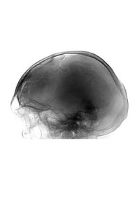Импрессионный перелом черепа: Рентгенодиагностика