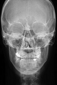 Импрессионный перелом лобной кости: Рентгенодиагностика