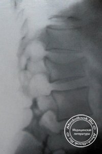 Компрессионный перелом 1 поясничного позвонка: Рентгенодиагностика