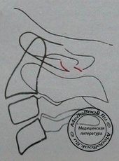 Схема к рентгеновскому снимку в боковой проекции аномалии развития атланта