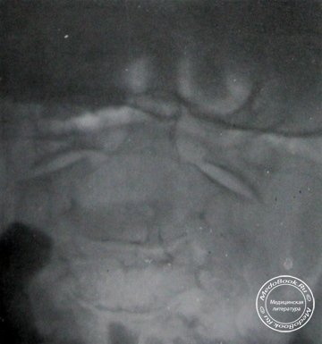 Рентгеновский снимок в трансоральной проекции аномалии развития атланта