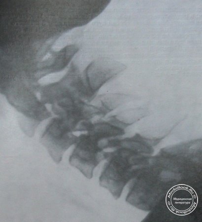 Рентгеновский снимок перелома дуги 2 и 3 шейных позвонков в боковой проекции