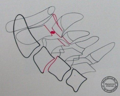 Схема к рентгеновскому снимку в боковой проекции перелома дуги 2 и 3 шейных позвонков