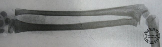 Рентгеновский снимок изолированного вывиха головки лучевой кости у детей в боковой проекции