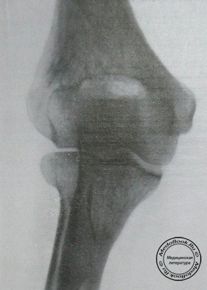 Рентгеновский снимок врожденного двустороннего вывиха головки правой лучевой кости в прямой проекции