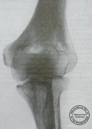 Рентгеновский снимок врожденного двустороннего вывиха головки левой лучевой кости в прямой проекции