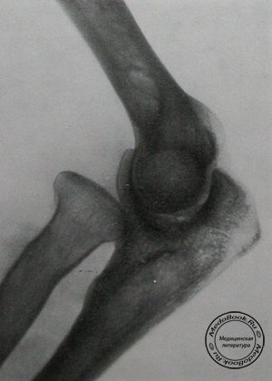 Рентгеновский снимок врожденного двустороннего вывиха головки правой лучевой кости в боковой проекции